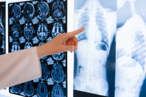 Celebrating 25 years of the Pulmonary Fibrosis Foundation: driving awareness, research, and support